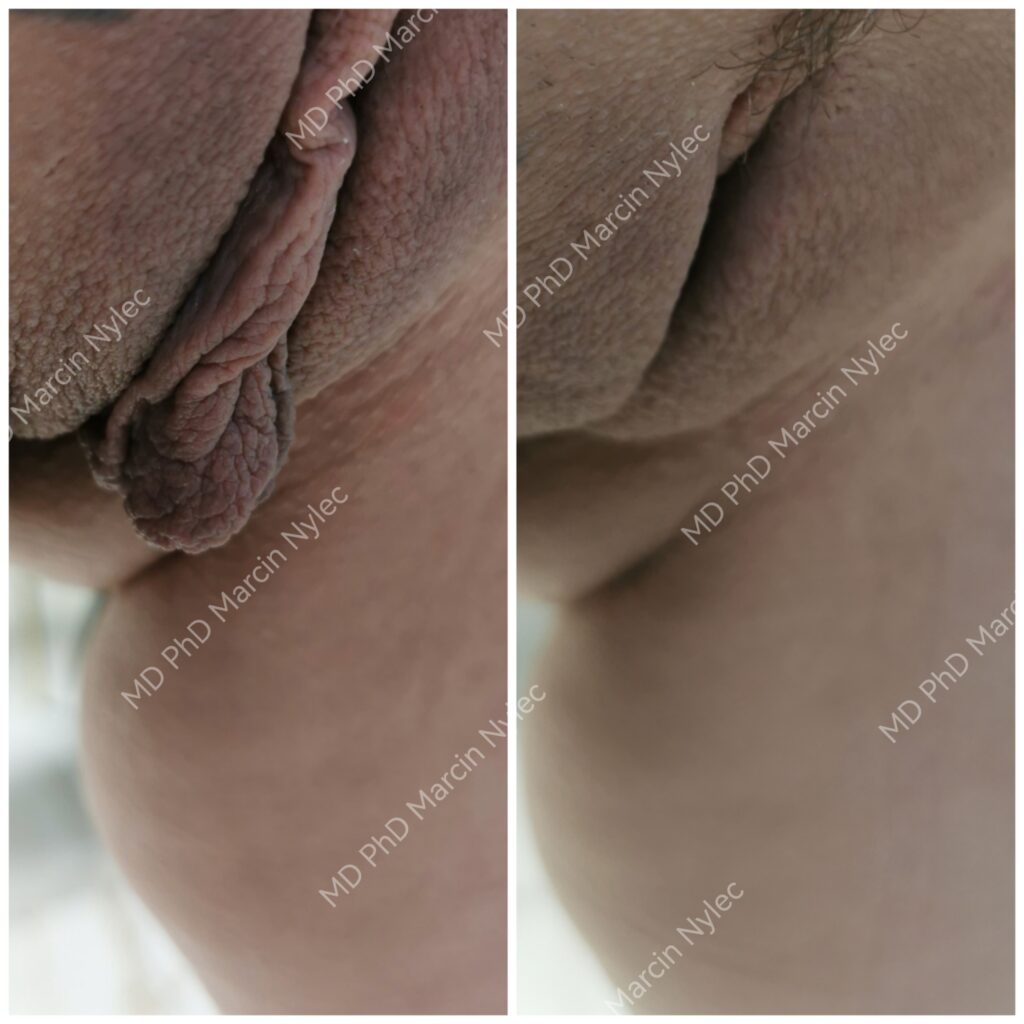 efekty labioplastyki pacjent 26