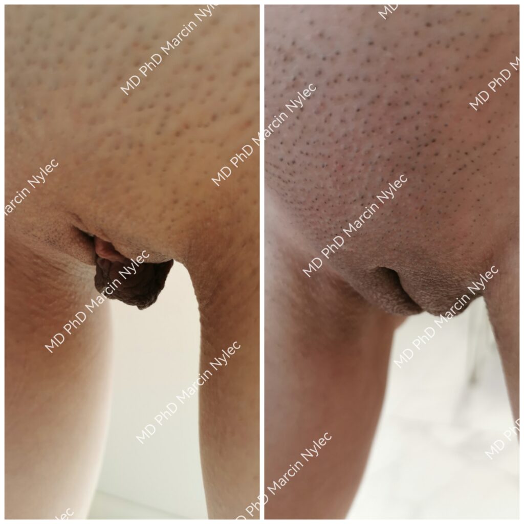 przed i po labioplastyce pacjent 36