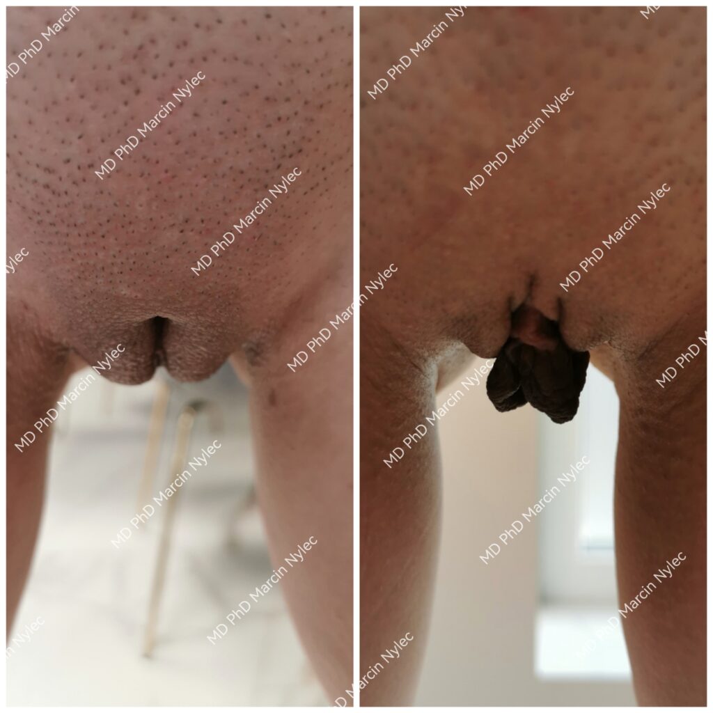 przed i po labioplastyce pacjent 38