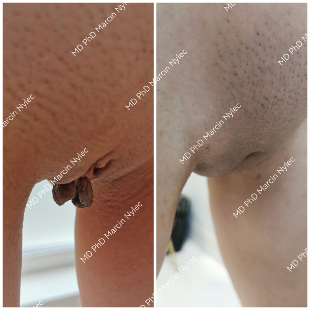 przed i po labioplastyce pacjent 39