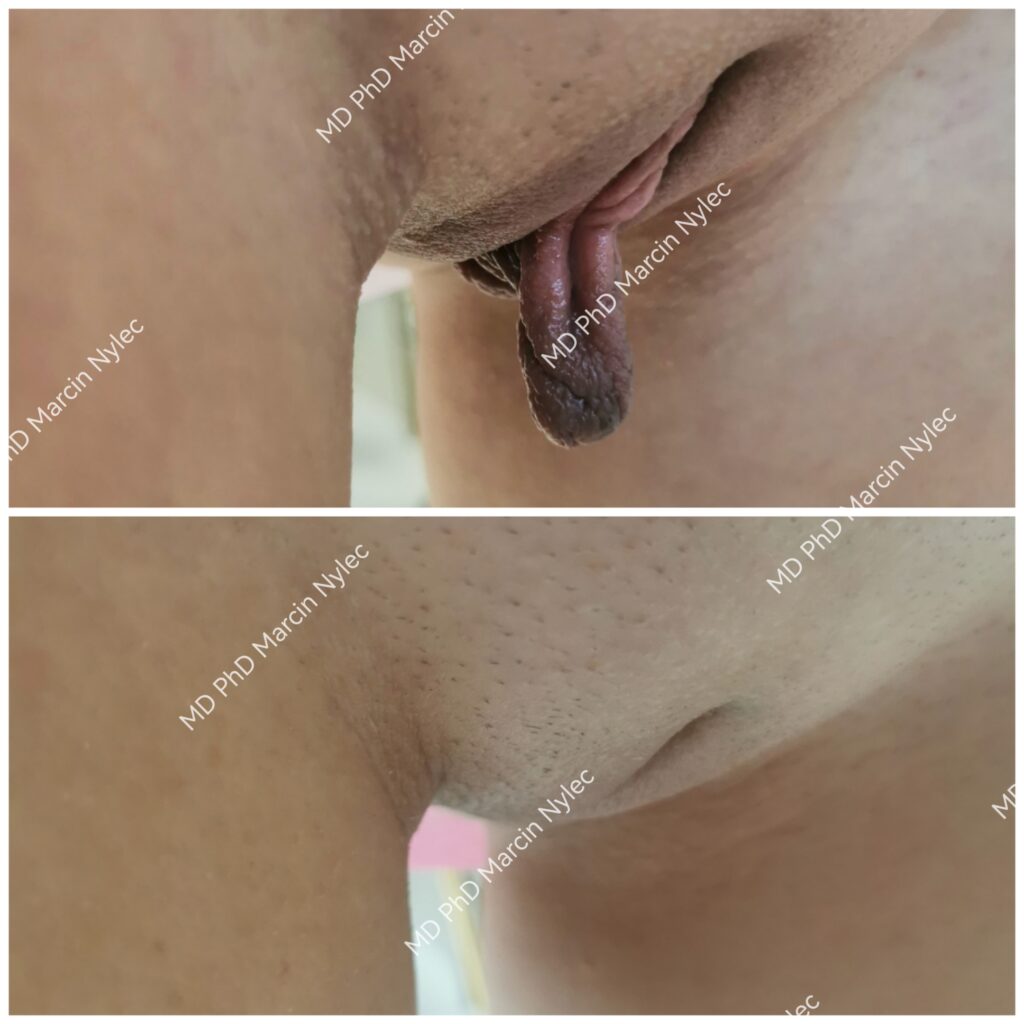 wrocław labioplastyka dr nylec pacjentka 41