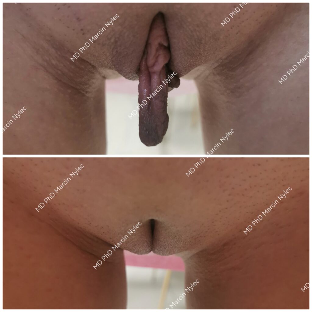 wrocław labioplastyka dr nylec pacjentka 48