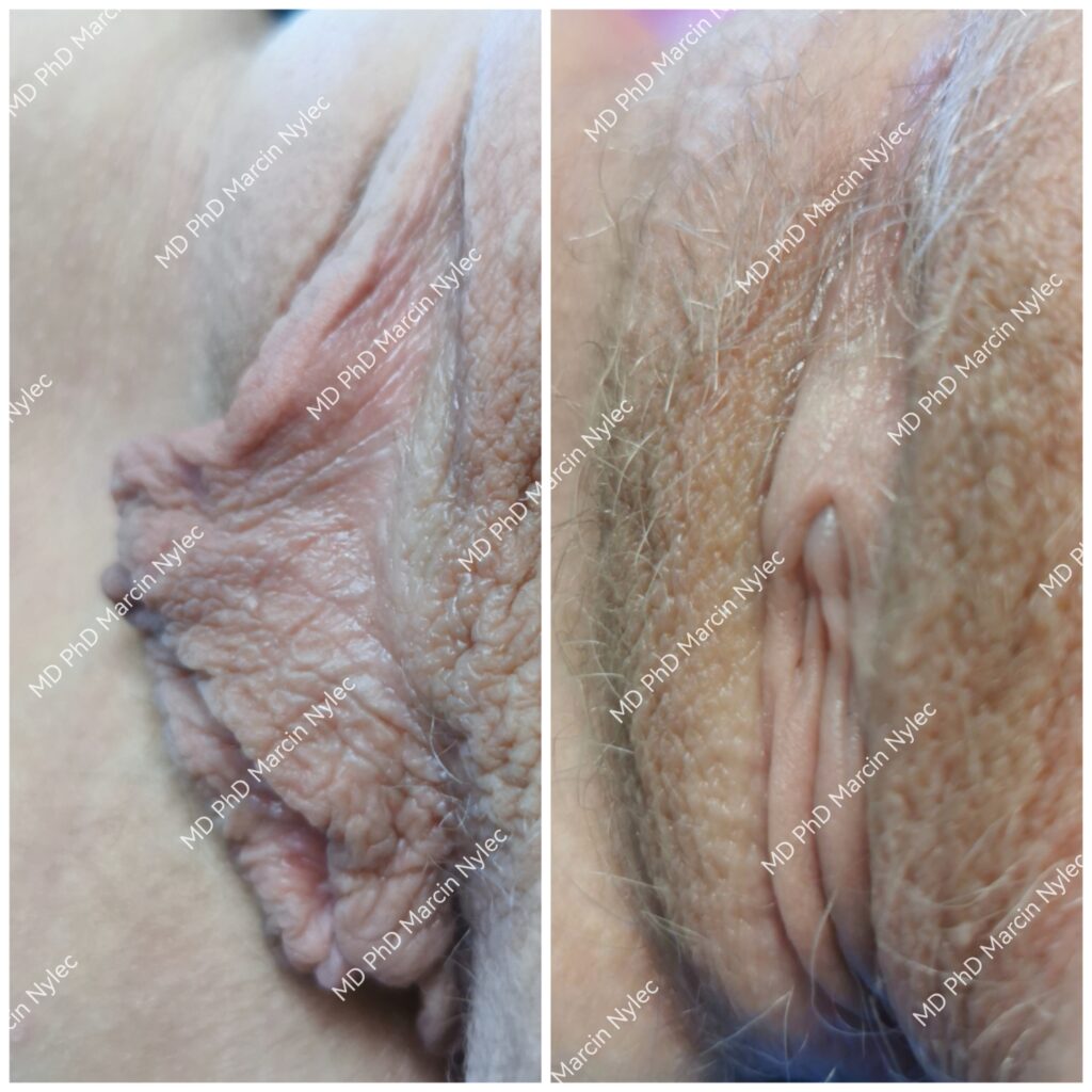 wrocław labioplastyka pacjent 14
